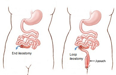 A) Illustrates functional loop ileostomy with stoma bag applied